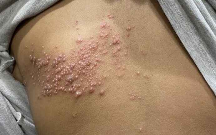 Helvedesild vaccine