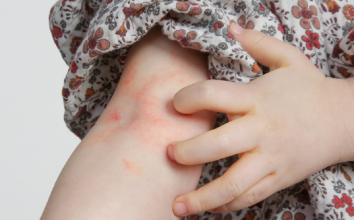 Der er mange muligheder for at behandle atopisk eksem