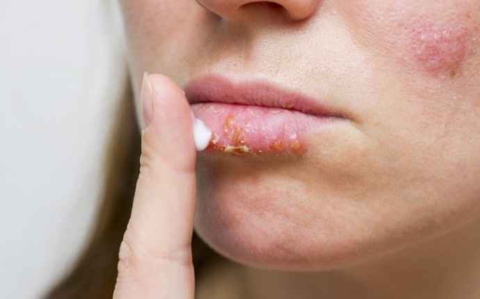 Forkølelsessår behandling