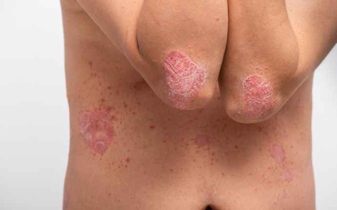 psoriasis