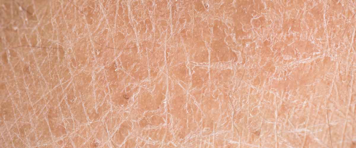 Hvorfor har jeg så tør hud?