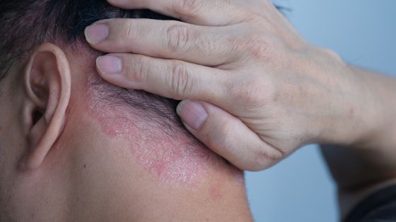 psoriasis4