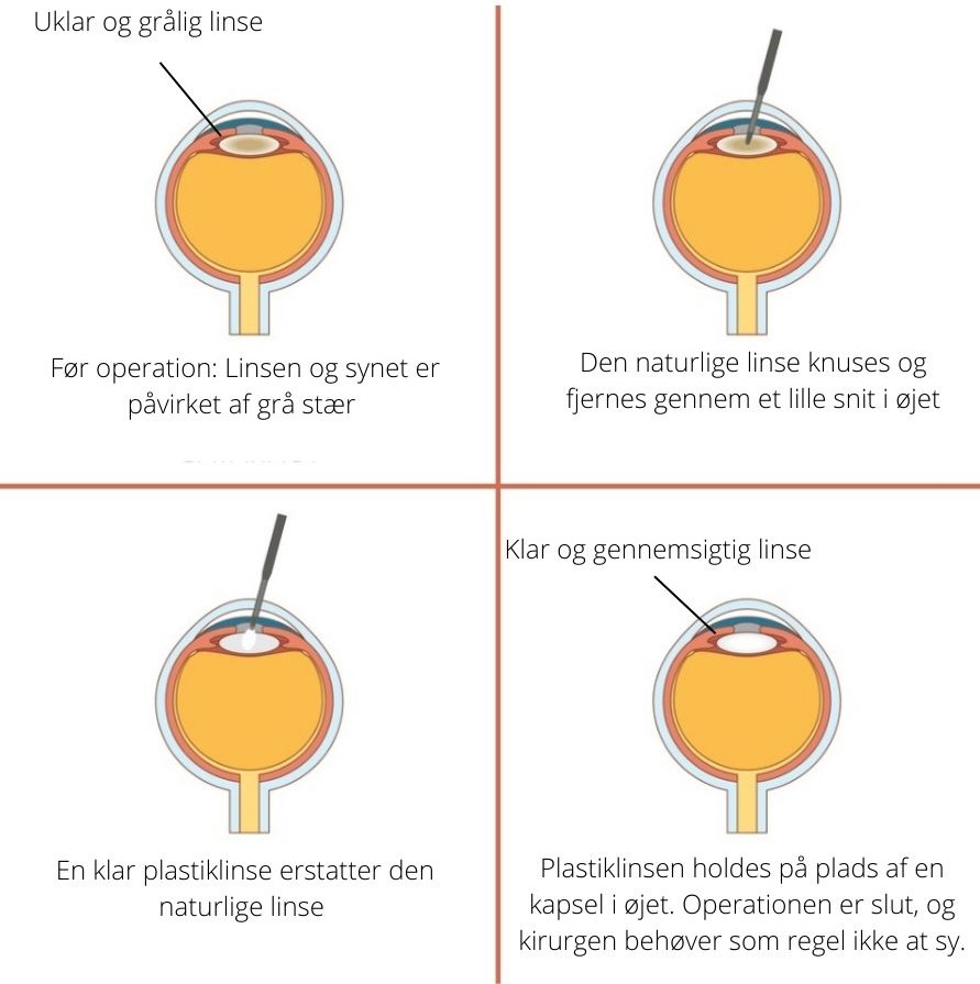 Operation for grå stær