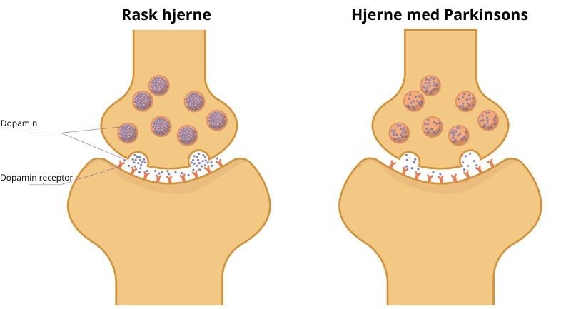 Underskud af dopamin i hjernen
