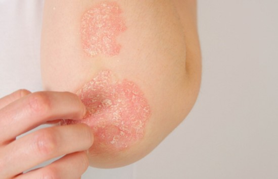 Psoriasis på albuen Psoriasis