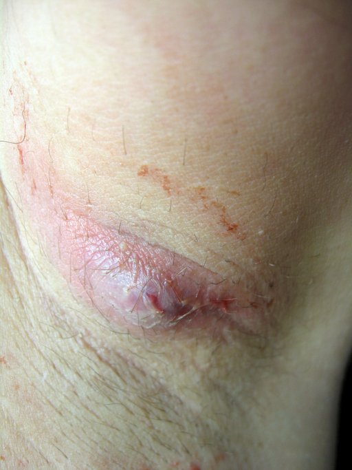 Hidrosadenitis Suppurativa (HS) byld. Vær opmærksom på, at bylder ved HS kan se forskellige ud. Udseendet afhænger blandt andet af placering, sværhedsgrad og dybde i huden. Hidrosadenitis Suppurativa HS