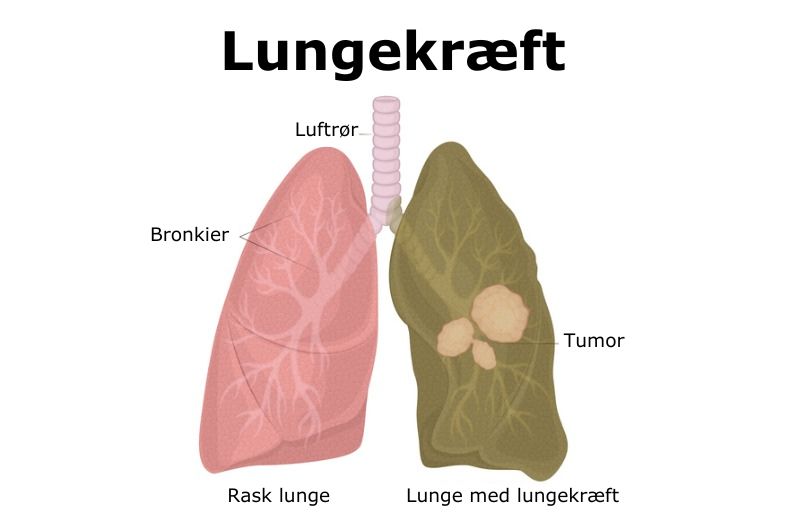 Rask lunge og lunge med kræft. Foto: IStock.com