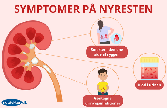 Symptomer på nyresten kan være smerter, blødninger og urinvejsinfektioner Symptomer pa nyresten